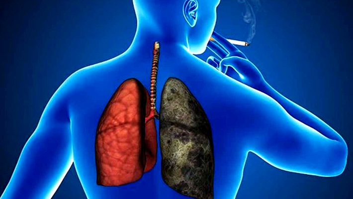 La lucha de Marisol Kovacic contra el cáncer de pulmón